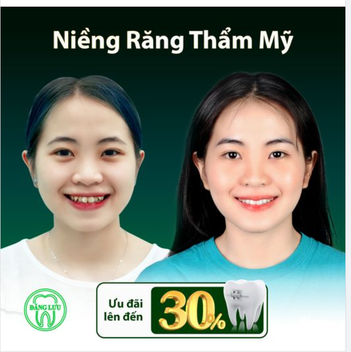 Thăng Hạng Nhan Sắc Sau Niềng Răng Với Ưu Đãi Lên Đến Hơn 30%