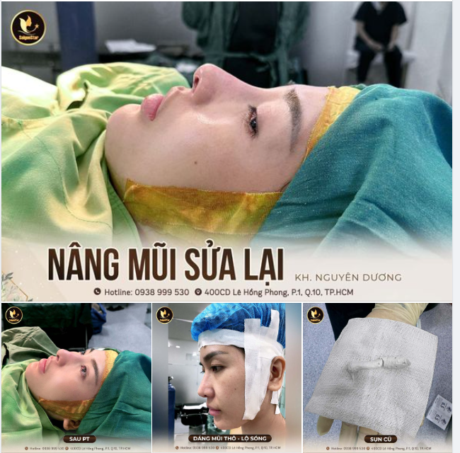 Sửa lại mũi hỏng an tòan – Tìm lại sự tự tin yêu đời!