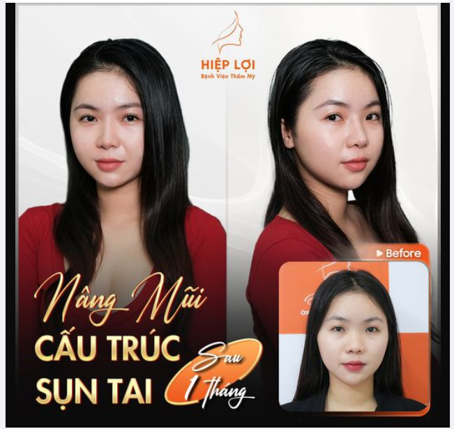 KẾT QUẢ SAU 1 THÁNG NÂNG MŨI CẤU TRÚC TUYỆT VỜI