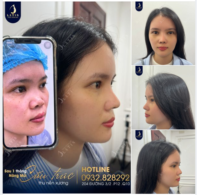 Một ca mũi khó nhưng đã thành công