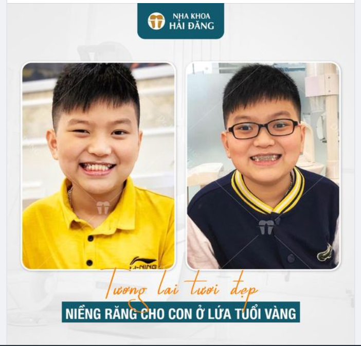 NIỀNG RĂNG CHO CON Ở LỨA TUỔI VÀNG