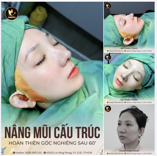 Mời cả nhà cùng chiêm ngưỡng góc nghiêng siêu nét sau 60 phút thực hiện NÂNG MŨI CẤU TRÚC SỤN SURGIFORM nhé!