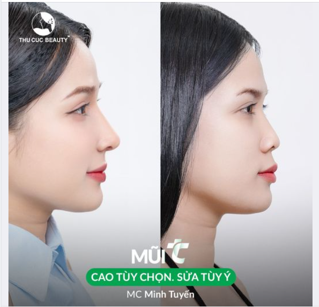 15 phút tạm biệt mũi thấp