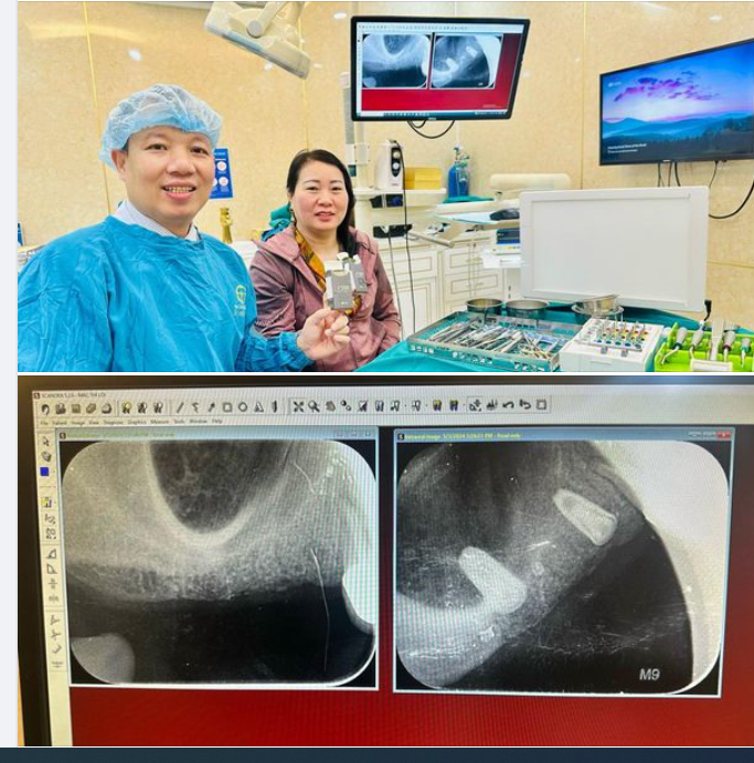 TRỒNG RĂNG IMPLANT GIẢI PHÁP TỐI ƯU CHO NGƯỜI MẤT RĂNG
