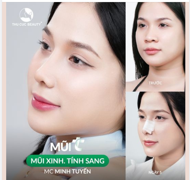 Tạm biệt sống mũi thấp. Đầu mũi bè chỉ sau 30P cùng MC Minh Tuyến