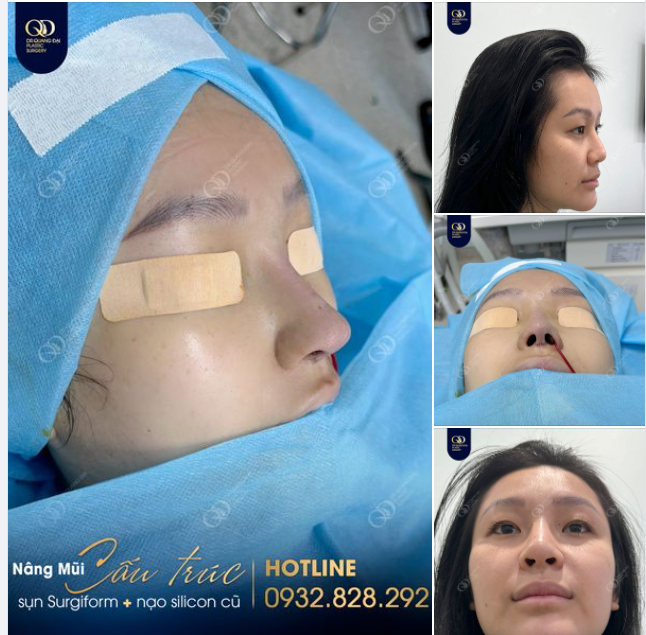 Biến chứng mũi vì trước đó tiêm filler có chứa sillicon, em gái quyết tới Latin tâm thay đổi dáng mũi mới