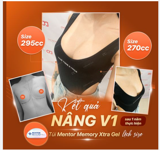 NÂNG V1 sau 1 năm, ngực "ốc vít" nay đã nảy nở căng tròn.