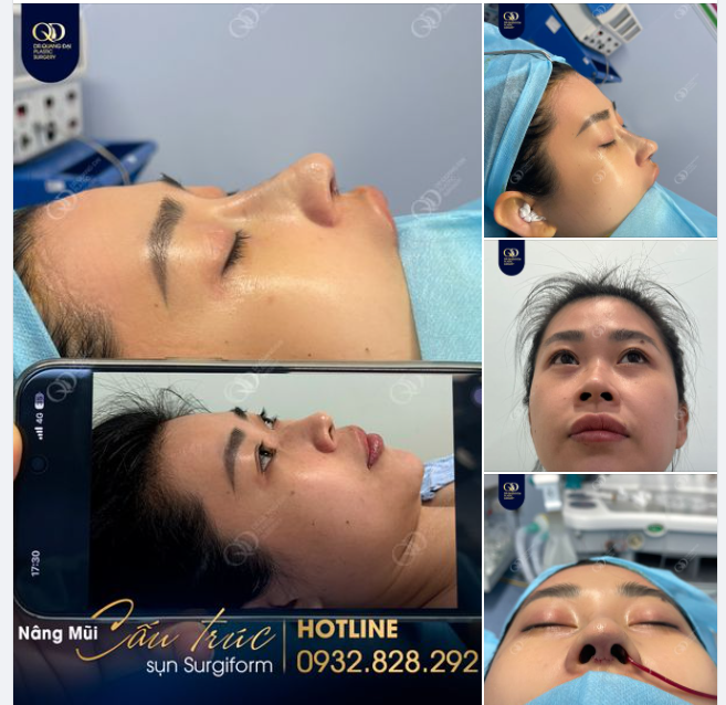 Mũi cấu trúc sụn tai, sóng surgiform, chỉnh gồ vừa hoàn thành cho chị khách đến từ Trà Vinh