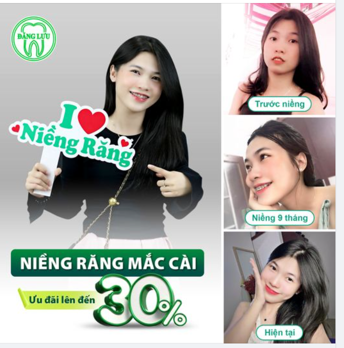Thăng Hạng Nhan Sắc Sau Niềng Răng Với Ưu Đãi Lên Đến Hơn 30%