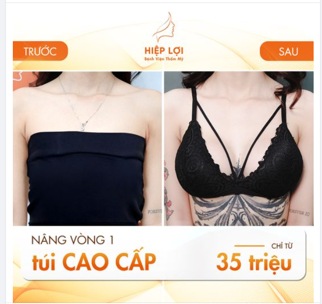 Nâng vòng 1 "cực cuốn hút", "khe quyến rũ" - Chỉ từ 35 triệu