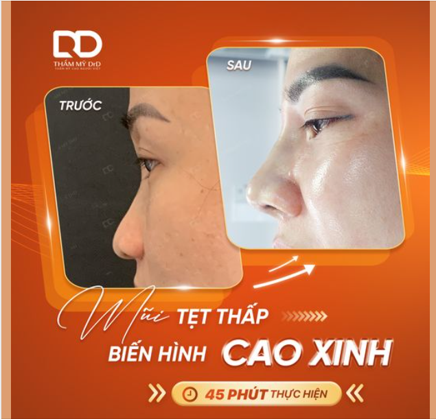 Can thiệp nhẹ nhàng với Nâng mũi Perfect Dform