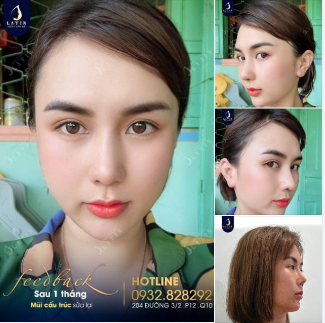Vượt qua nỗi sợ, chị H.T thay đổi dáng mũi cũ để có tự tin và nhiều cơ hội hơn