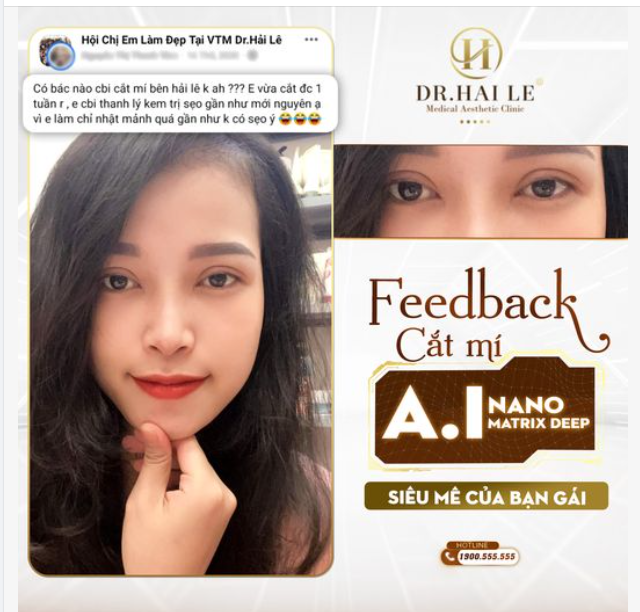 Feedback cắt mí A.I Nano Matrix Deep siêu mê của bạn gái
