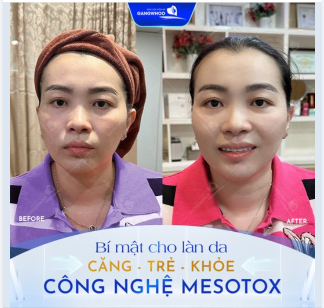 CÔNG NGHỆ MESOTOX Bí mất cho làn da căng, trẻ, khỏe