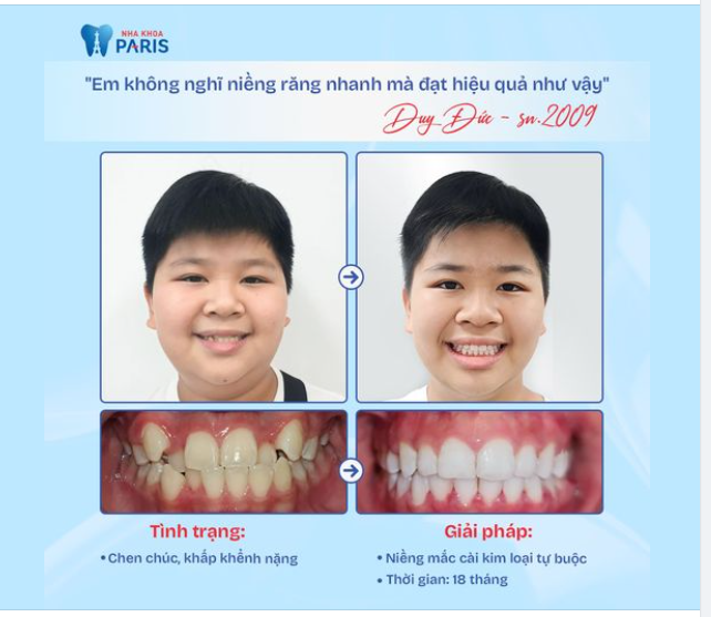 CẢI THIỆN RĂNG CHEN CHÚC LỆCH LẠC CHỈ SAU 18 THÁNG NIỀNG MẮC CÀI