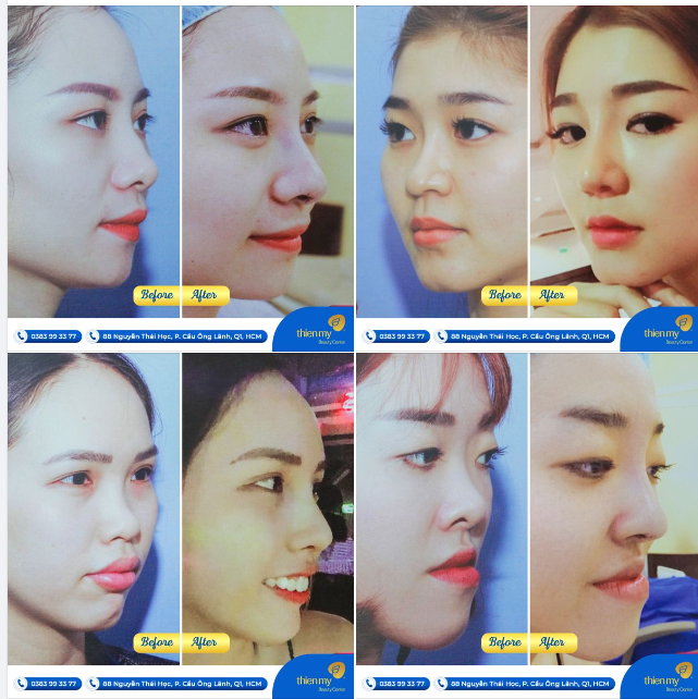 Điều quan trọng nhất để có được một dáng mũi đẹp tự nhiên và cuốn hút mọi ánh nhìn chính là tay nghề của bác sĩ.