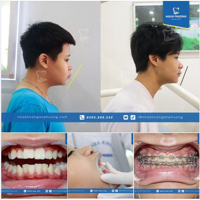 Tháo niềng trước nghỉ lễ, chúc mừng Gia Hưng “dậy thì thành công”