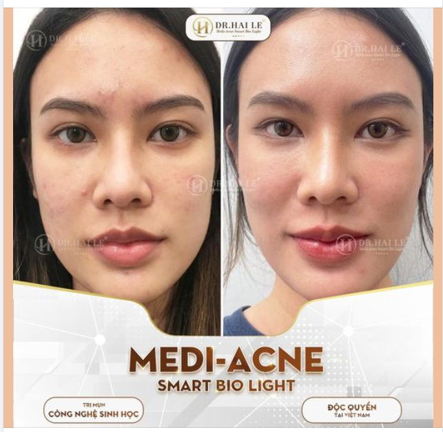 Mụn khó đã có  MEDI- ACNE SMART BIO LIGHT