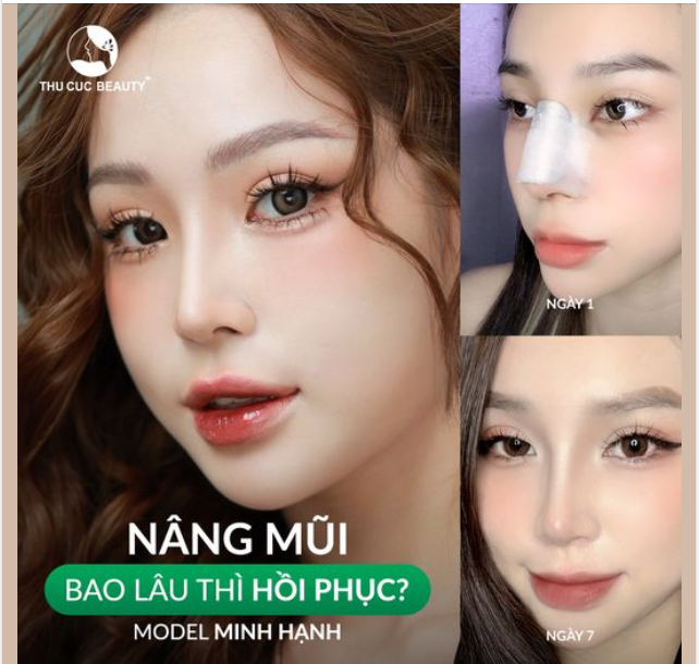 Nâng mũi bao lâu thì hồi phục ?
