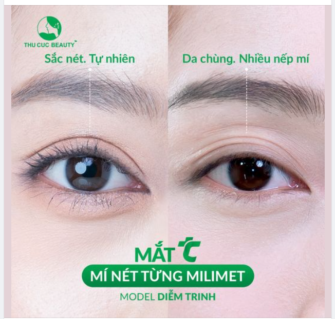 Đẹp từng milimet với cắt mí TC