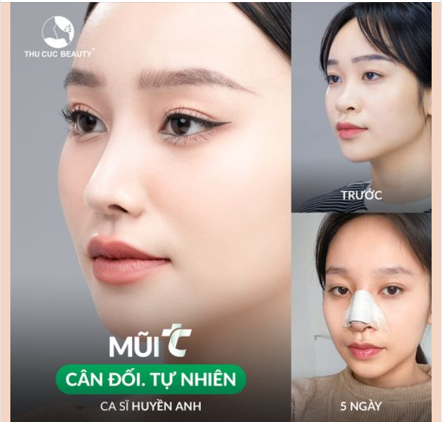 Chia tay mũi tẹt, cánh mũi to với Mũi TC