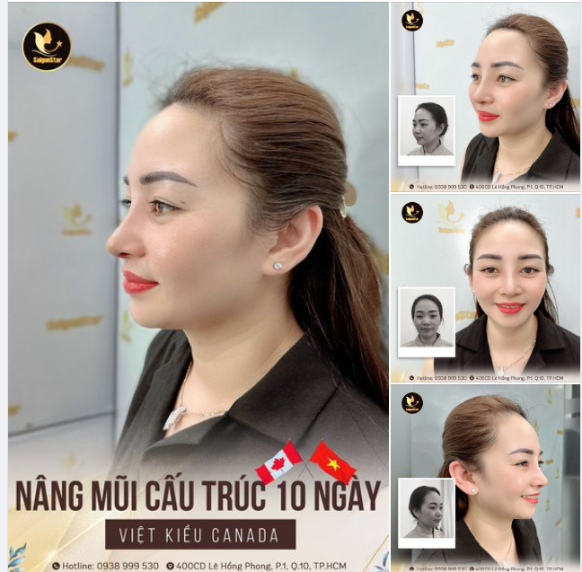 THĂNG HẠNG NHAN SẮC SAU 10 NGÀY NÂNG MŨI CẤU TRÚC KH. VIỆT KIỀU CANADA
