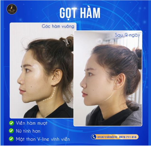 HÉ LỘ HÌNH ẢNH HẬU GỌT HÀM 9 NGÀY