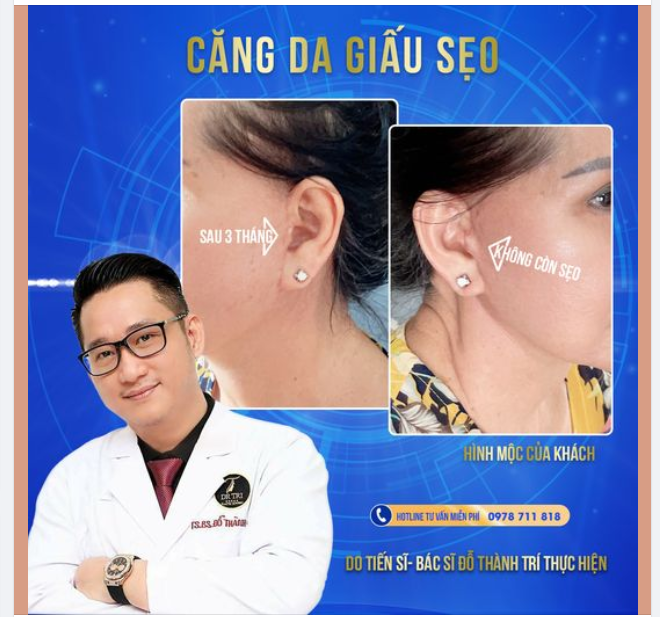 Hình MỘC cận cảnh đường may căng da KHÔNG SẸO của cô khách U70