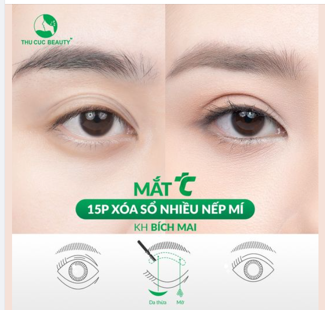 Xóa sổ mắt nhiều nếp mí chỉ với 45 phút tại TC