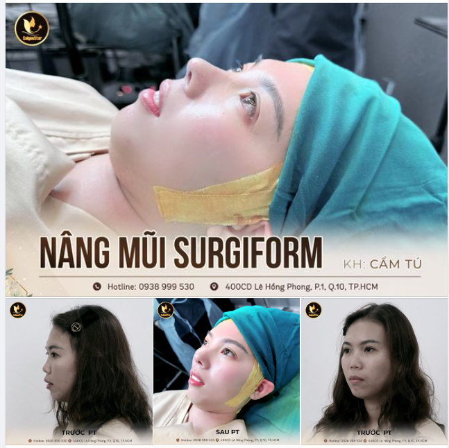 KẾT QUẢ SIÊU THỰC SAU 60 PHÚT NÂNG MŨI CẤU TRÚC SỤN SURGIFORM