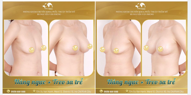 Mẹ Bỉm 2 con sở hữu ngay V.òng 1 quyến rũ, hút trọn ánh nhìn sau combo N.âng ng.ực kết hợp treo sa trễ cấp độ nhẹ.