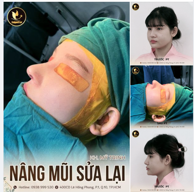 SỬA LẠI MŨI HỎNG – ĐẸP CHUẨN MỌI GÓC NHÌN