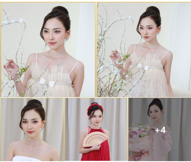 Kết quả mãn nhãn sau giải pháp nâng mũi cấu trúc thu hẹp xương