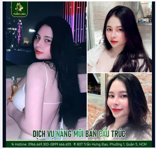Sở hữu góc nghiêng đẹp chuẩn sau nâng mũi!