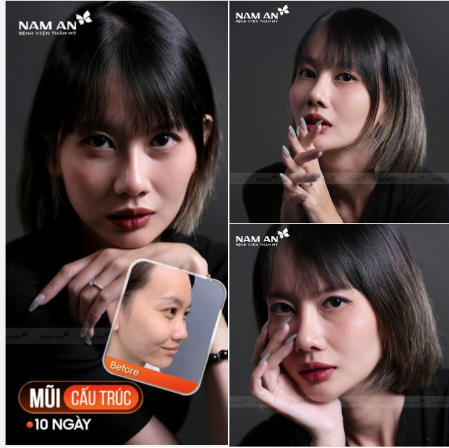 NÂNG MŨI THAY ĐỔI NHAN SẮC
