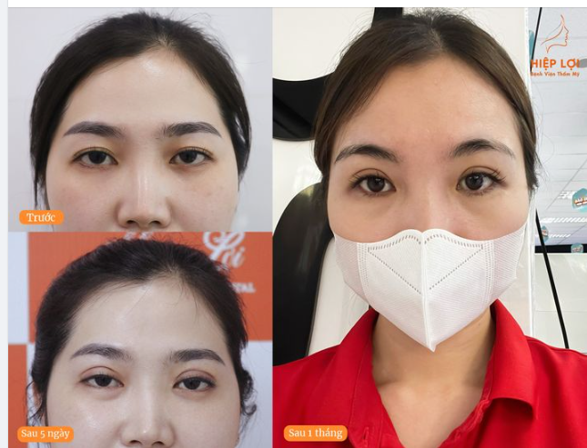 FEEDBACK khách hàng "Cắt mí" - Sau 1 tháng