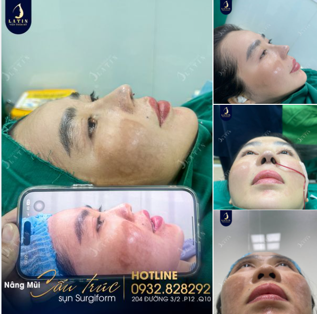 Thiết kế dáng mũi cao nét pha nét Trung Hoa cho chị gái đến từ Sa Đéc