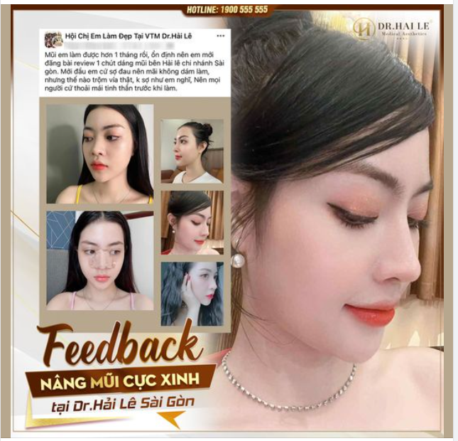 Feedback nâng mũi cực xinh tại Dr Hải Lê