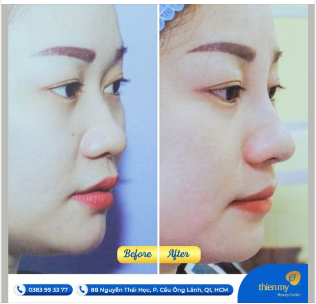 "Tôi từng nghĩ mình không xinh đẹp….cho đến khi tôi tìm được một địa chỉ nâng mũi uy tín chất lượng và hết sức dễ thương.