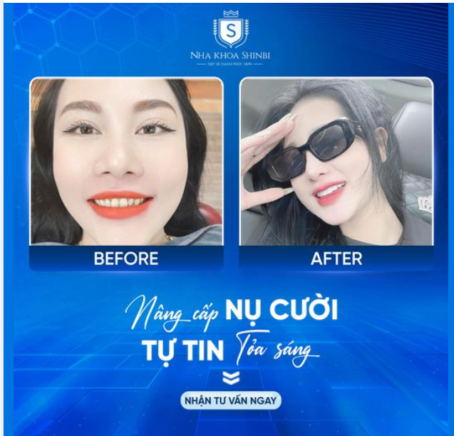 NÂNG CẤP NỤ CƯỜI - TỰ TIN TOẢ SÁNG