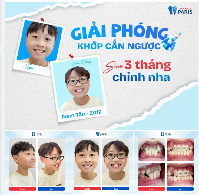 BỐ MẸ ƠI! CON MUỐN NIỀNG RĂNG SỚM!!!
