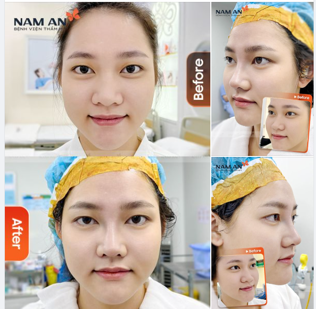 NÂNG MŨI THAY ĐỔI 50% NHAN SẮC