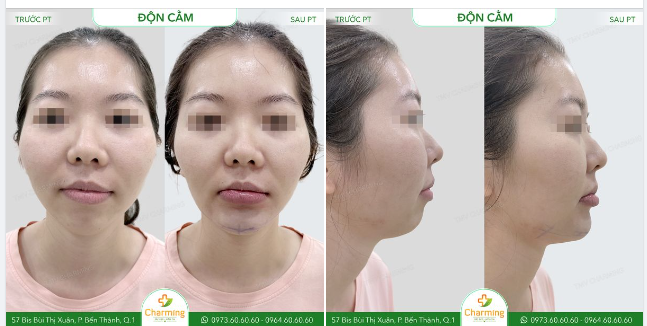 Một chiếc cằm lẹm tưởng không ảnh hưởng nhưng lại tác động đến tổng thể gương mặt nhiều hơn chúng ta nghĩ.