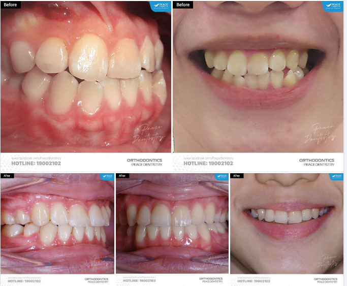 THỜI GIAN ĐIỀU TRỊ VỚI NHỮNG CA CHỈNH NHA PHỨC TẠP