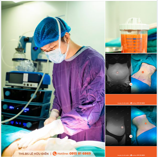 "Chiến lợi phẩm" thu được sau mỗi ca hút mỡ