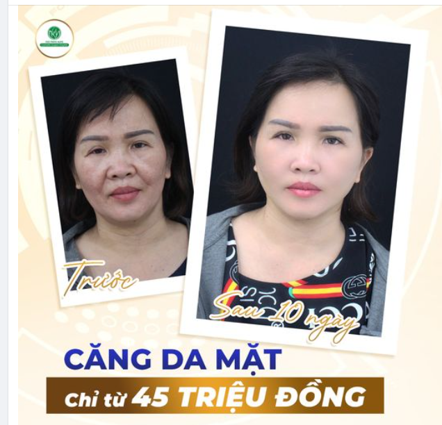 CHIỀU NAY CÓ CHỊ KHÁCH BAY TỪ ÚC VỀ VN NGÀY MAI PT CĂNG DA MẶT