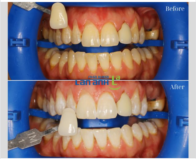 Tẩy trắng răng bằng hệ thống Zoom tại nha khoa Lan Anh, kết quả là rõ ràng và luôn được kiểm chứng với cây so màu răng nha