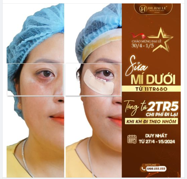 Bạn phải rinh ngay loạt ưu đãi không thể bỏ lỡ khi sửa mí tại DR Hải Lê