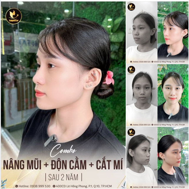 Màn lột xác ngoạn mục của cô nàng gen Z sau 2 năm thực hiện COMBO NÂNG MŨI + ĐỘN CẰM + CẮT MÍ  Xinh xắn hơn – tự tin hơn – ĐIỂM 10 CHO CHẤT LƯỢNG!