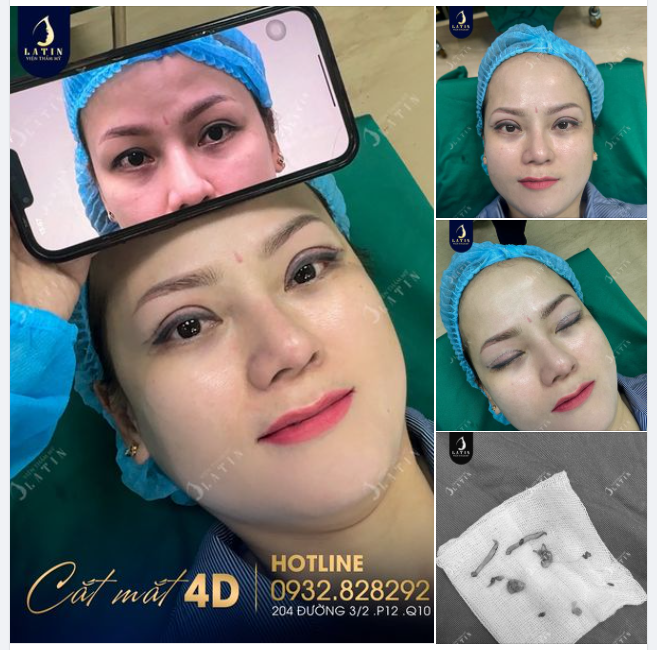 Giải cứu đôi mắt mí không đều, bên to bên nhỏ